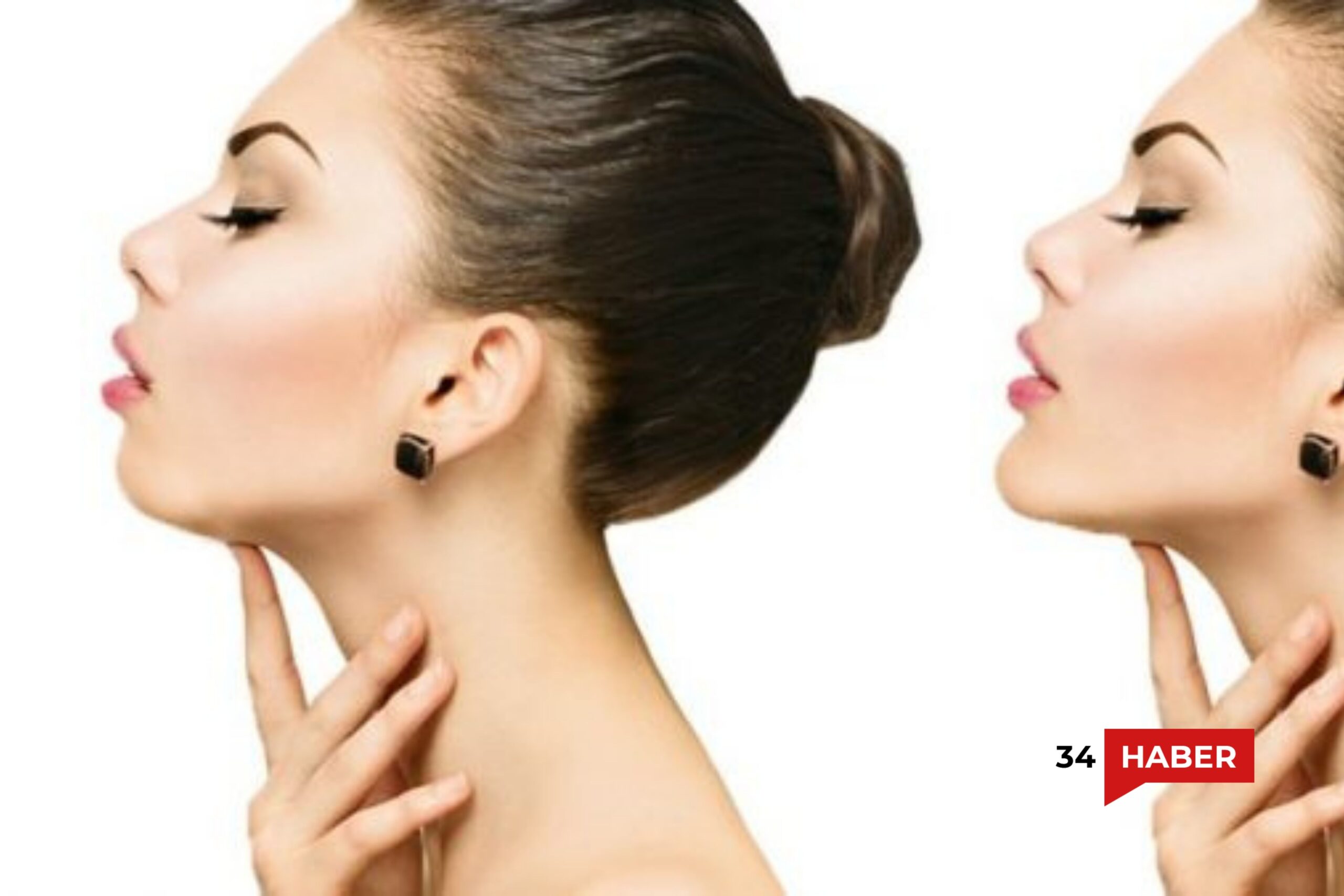 jawline dolgusu nedir